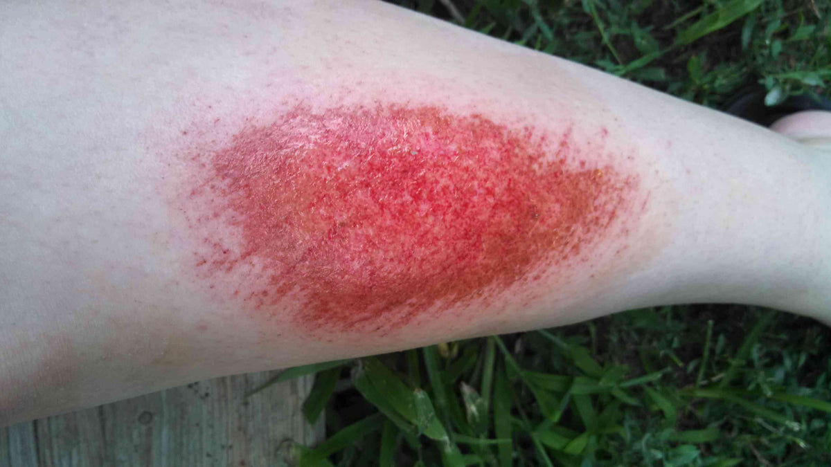 The Healing Power of Red Light and Near-Infrared Light on Burns – Kivo ...