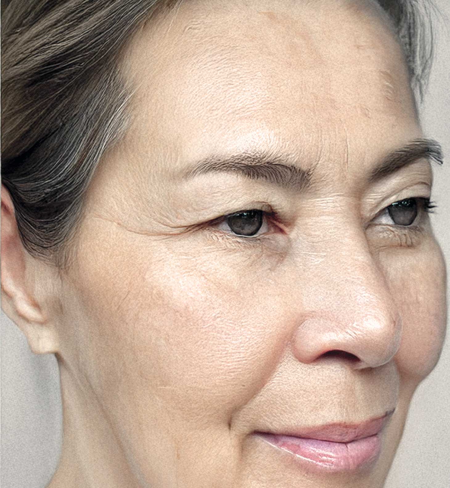 Joan after light therapy mask led