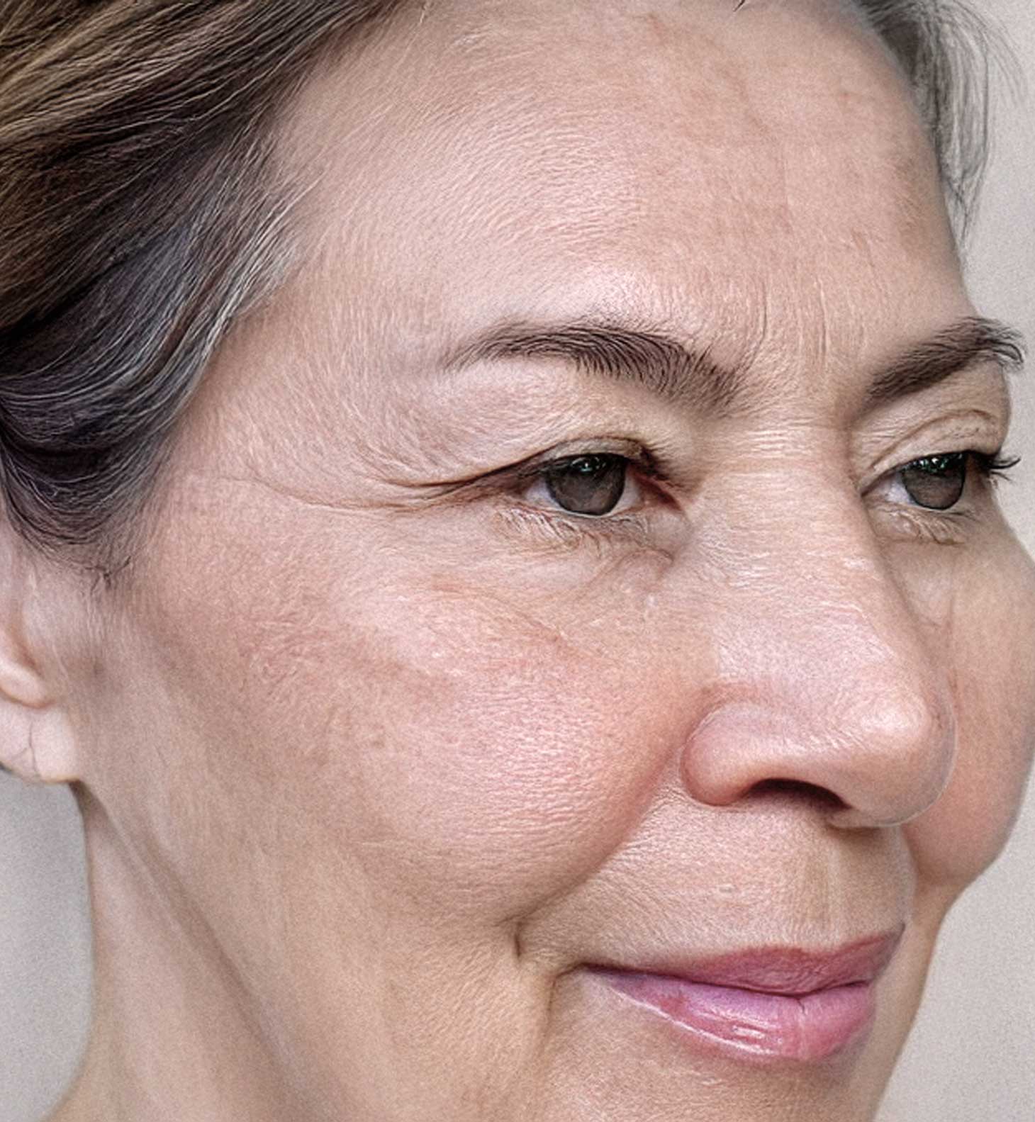 Joan before light therapy mask led